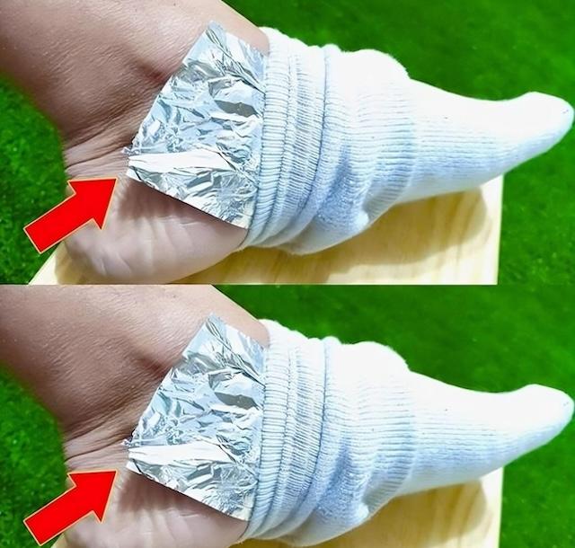 Wrapping aluminum foil around your heel may provide relief for pain or discomfort, as part of a popular home remedy.